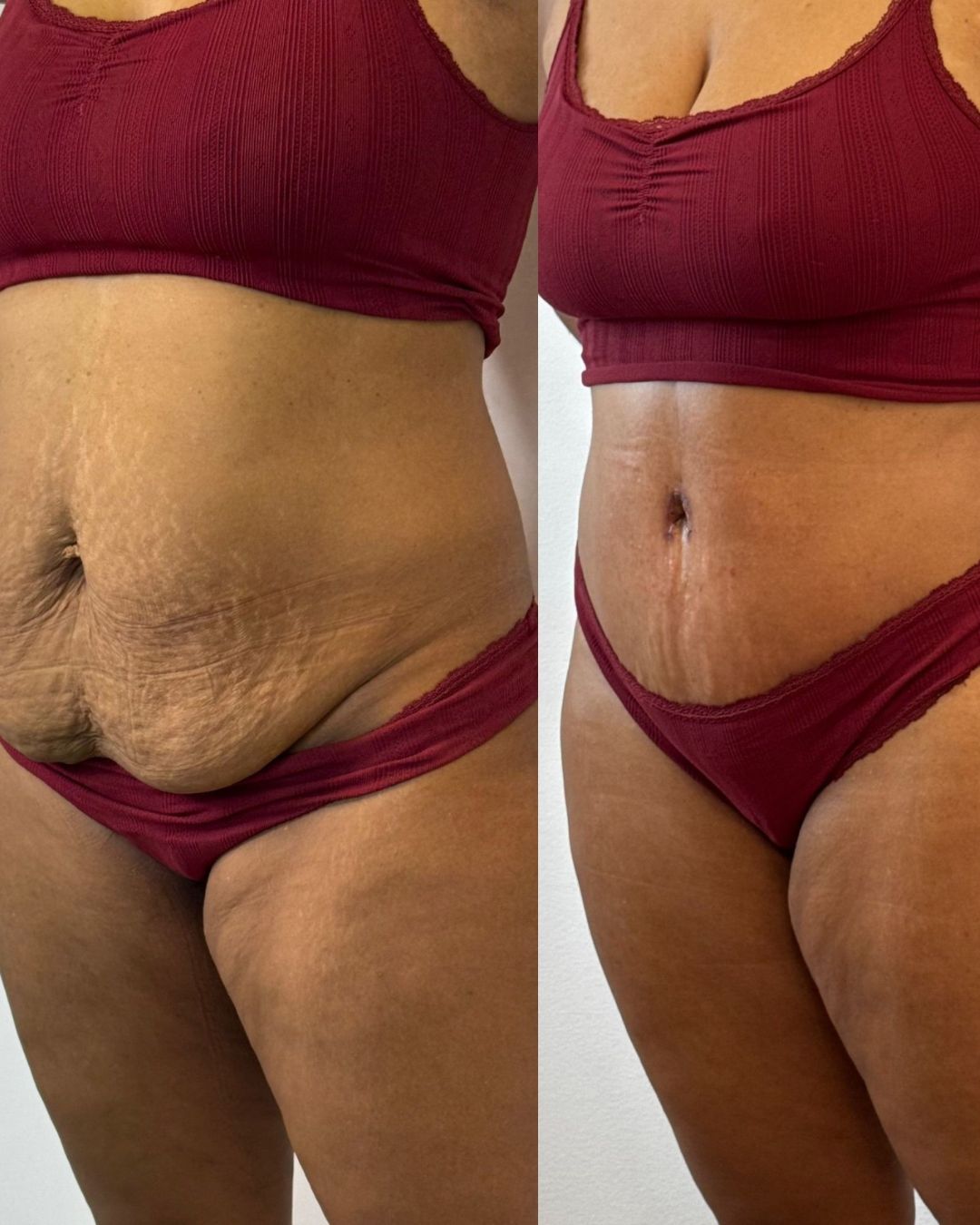 Liposucción una zona · Reserva primera visita 100€